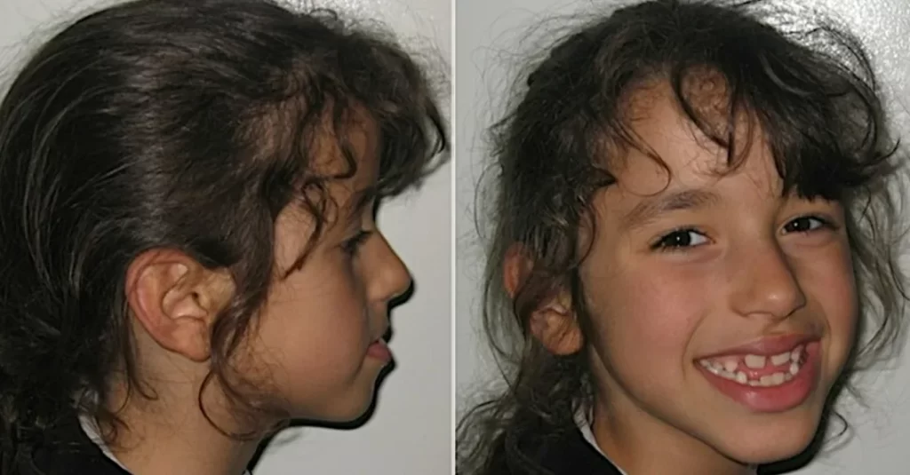 Jaw Underbite Class III Malocclusion